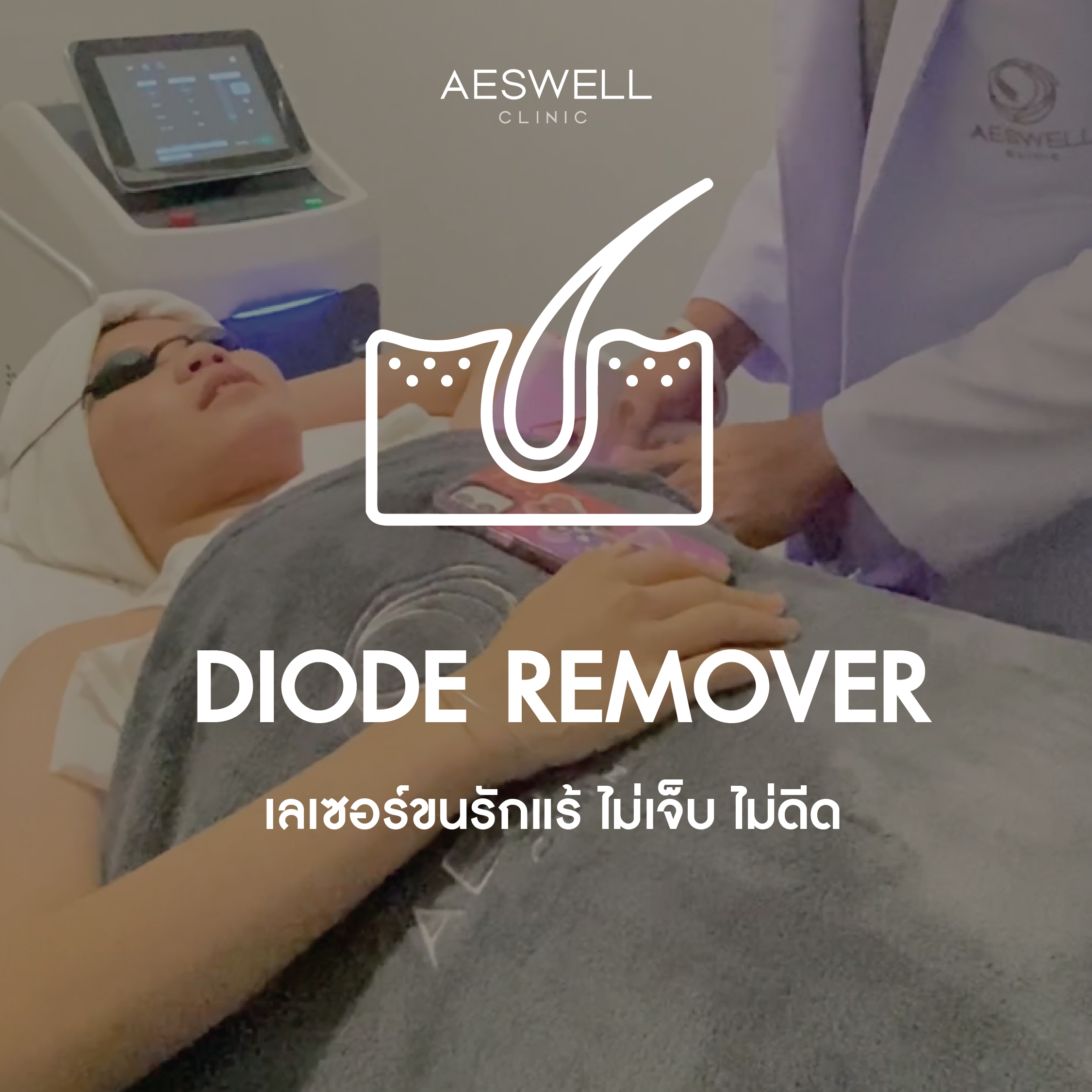 โปรแกรม DIODE เลเซอร์ขนรักแร้ โปรแกรม DIODE เลเซอร์ขนรักแร้