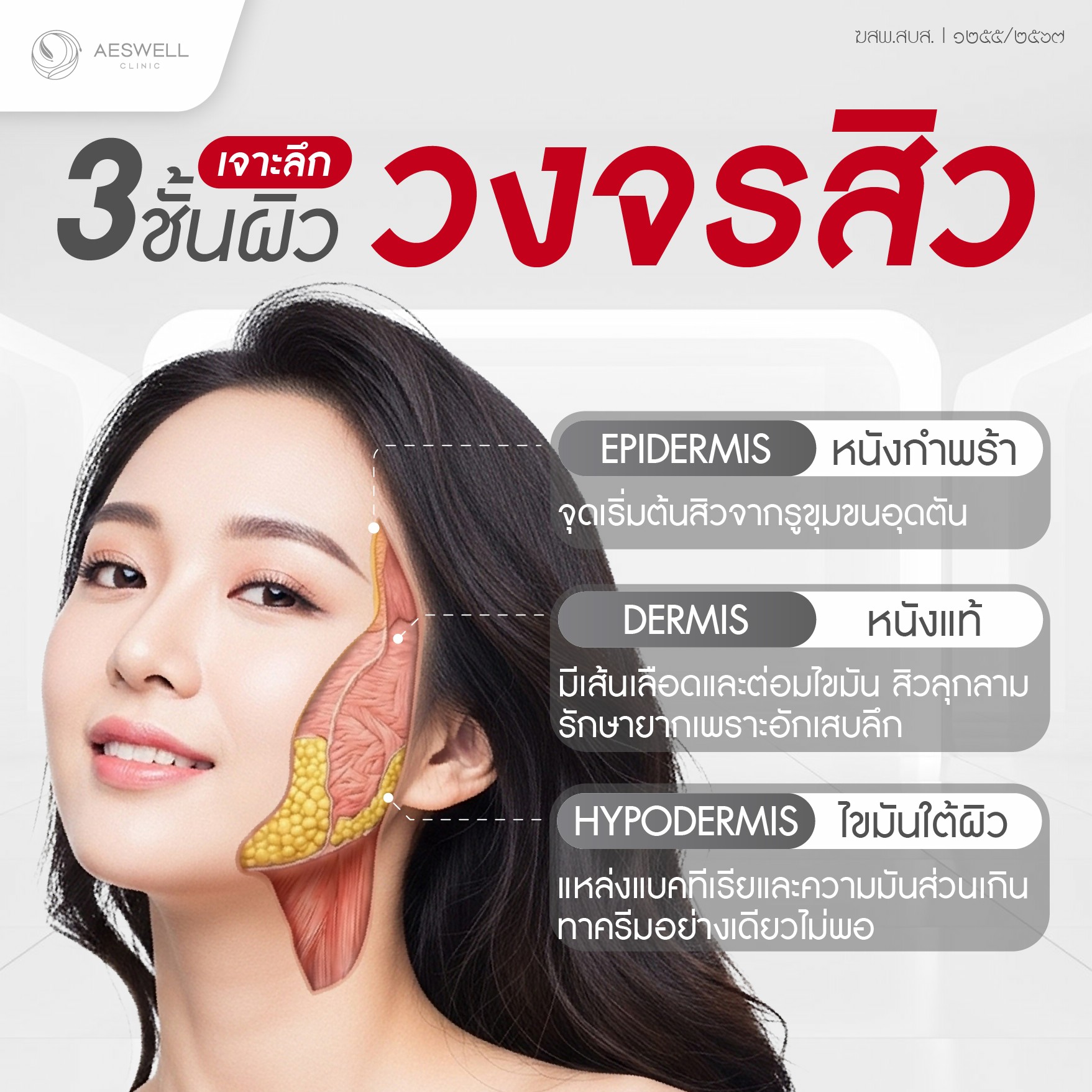สิวแต่ละชนิดอยู่ชั้นผิวไหน?