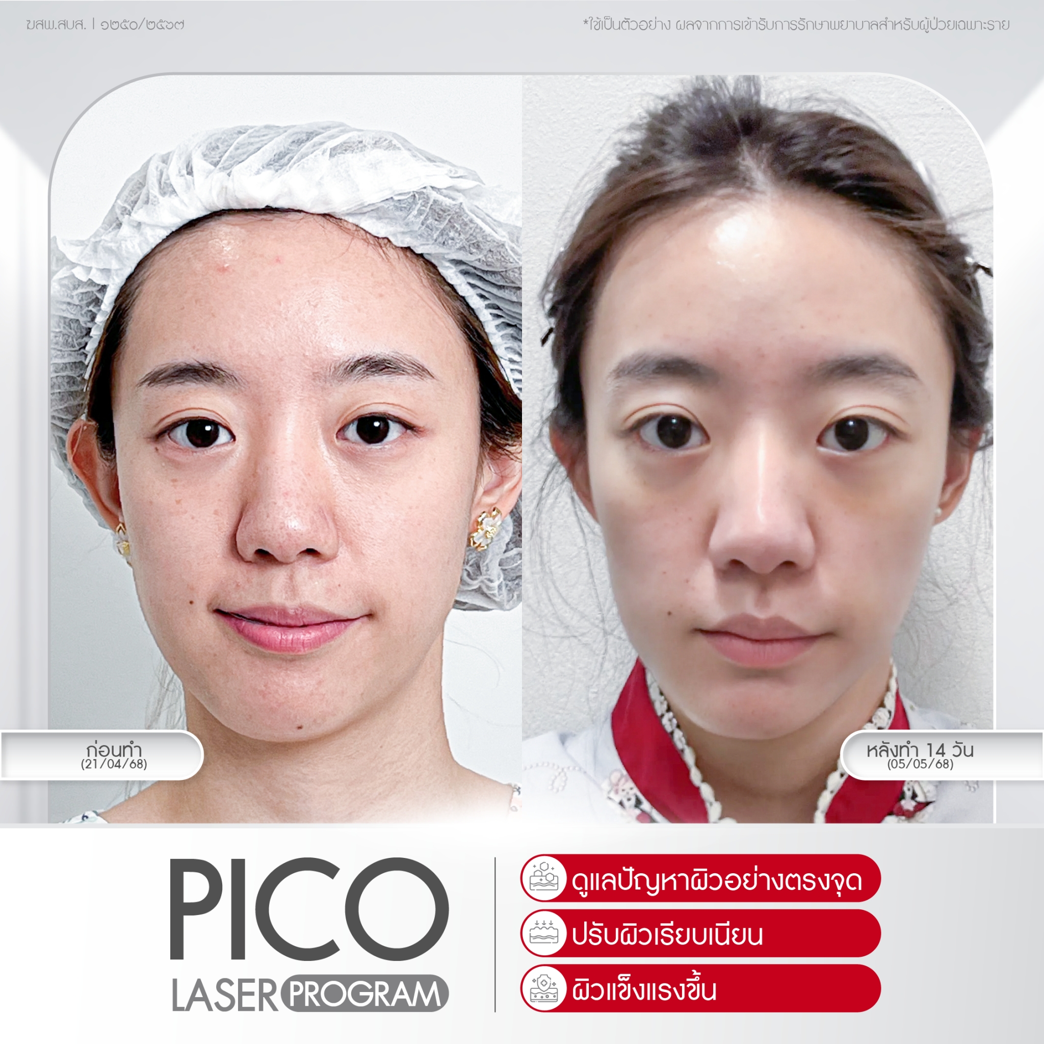 รอยสิว รอยแดง