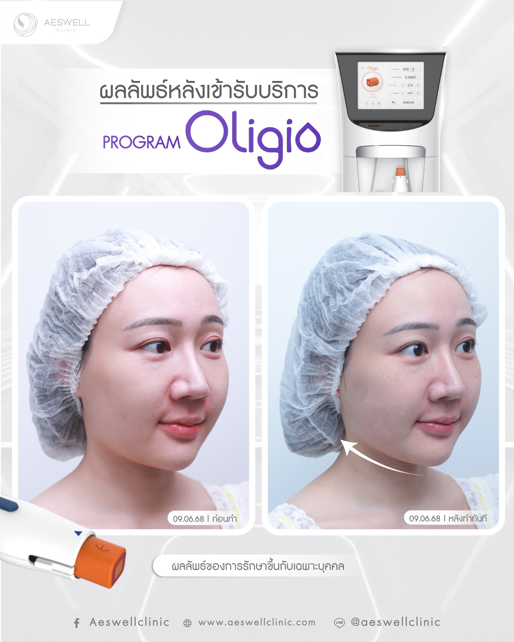 รีวิวหลังทำ โปรแกรม Oligio
