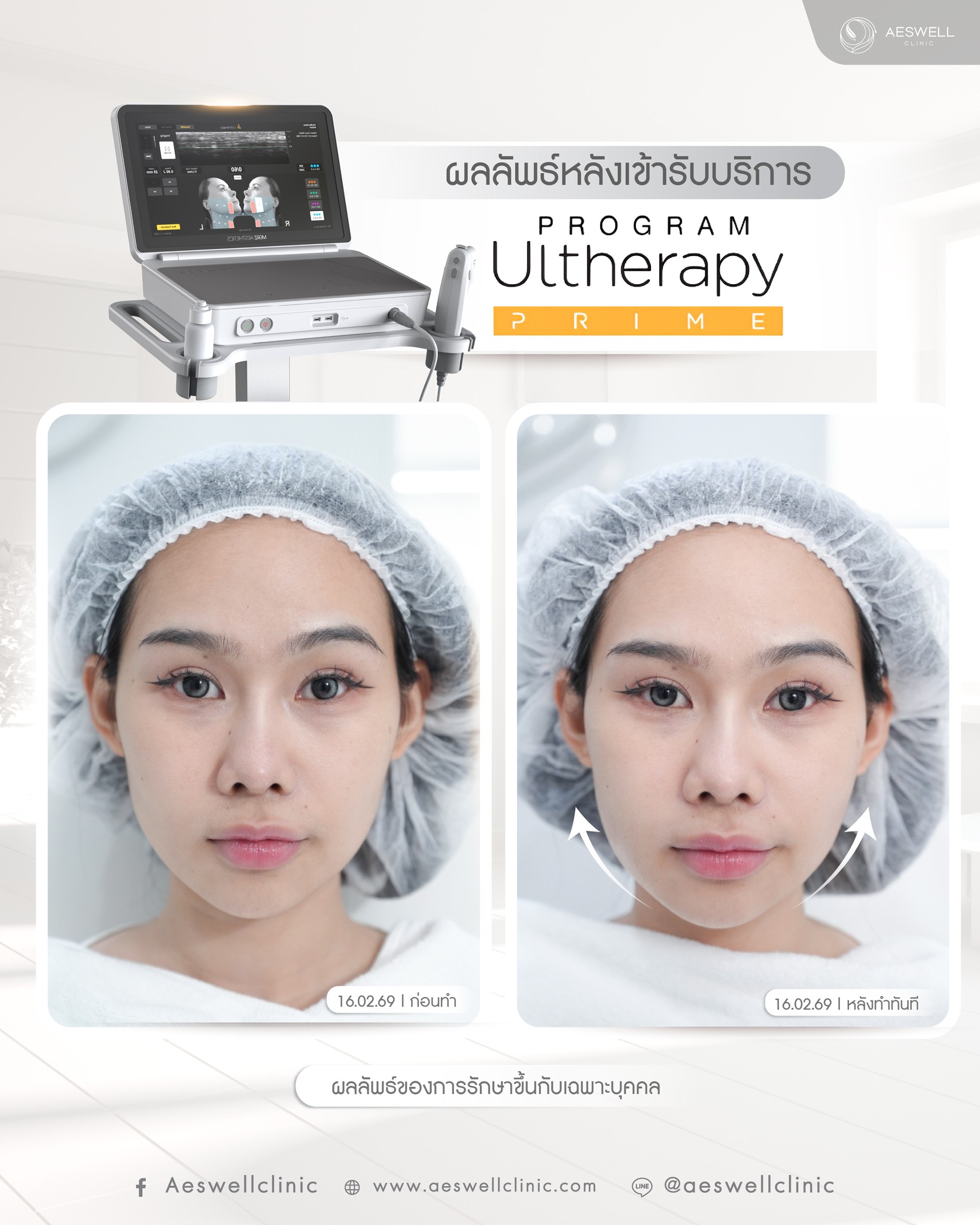 ผลลัพธ์หลังทำ โปรแกรม Ultherapy Prime
