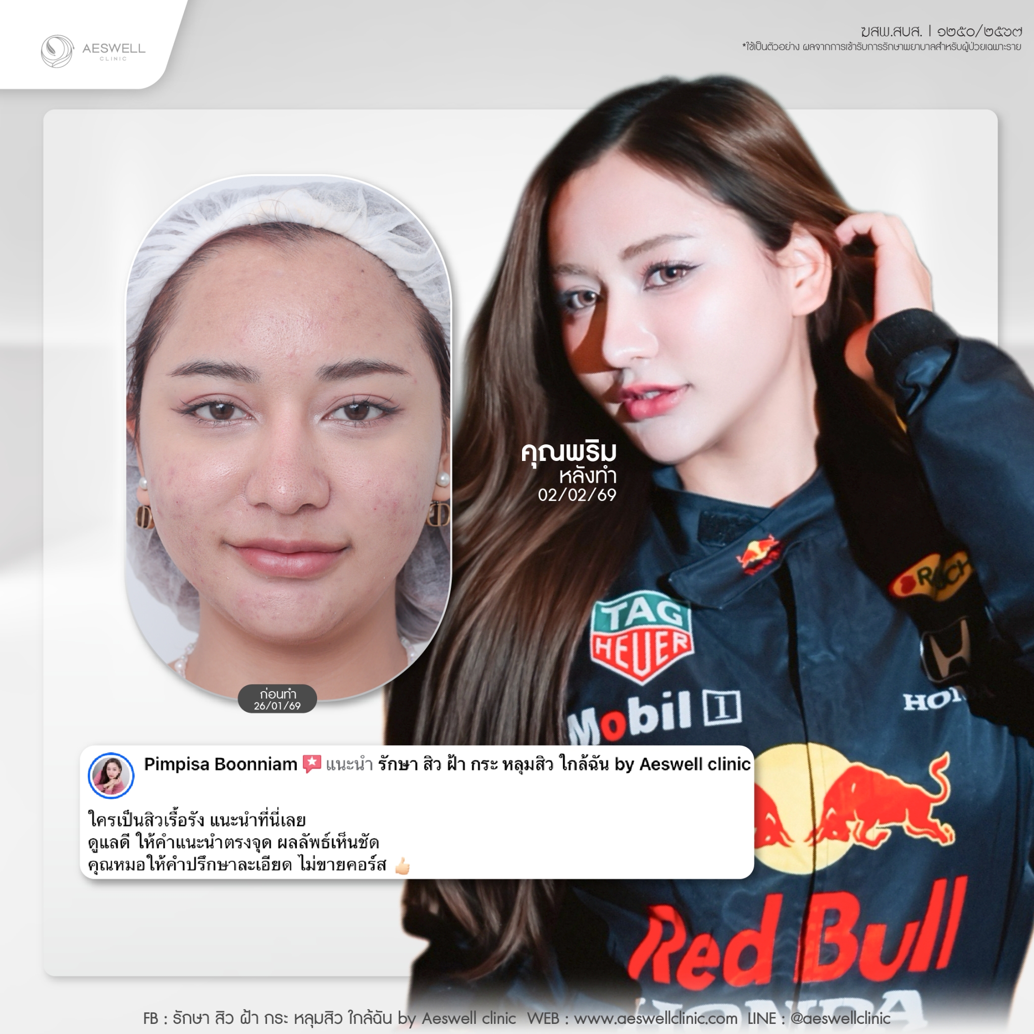 รีวิว รักษาสิว