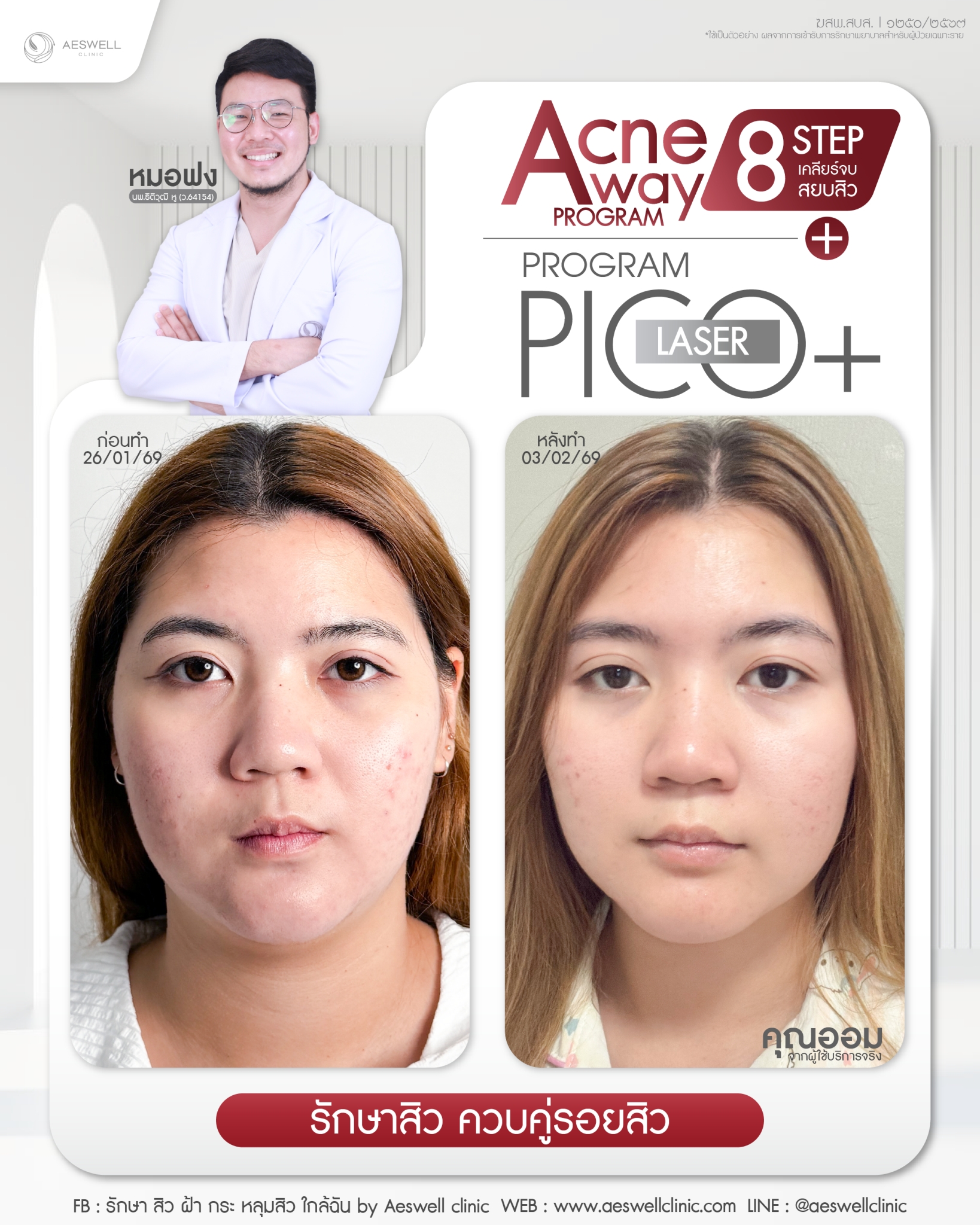 รีวิว รักษาสิว