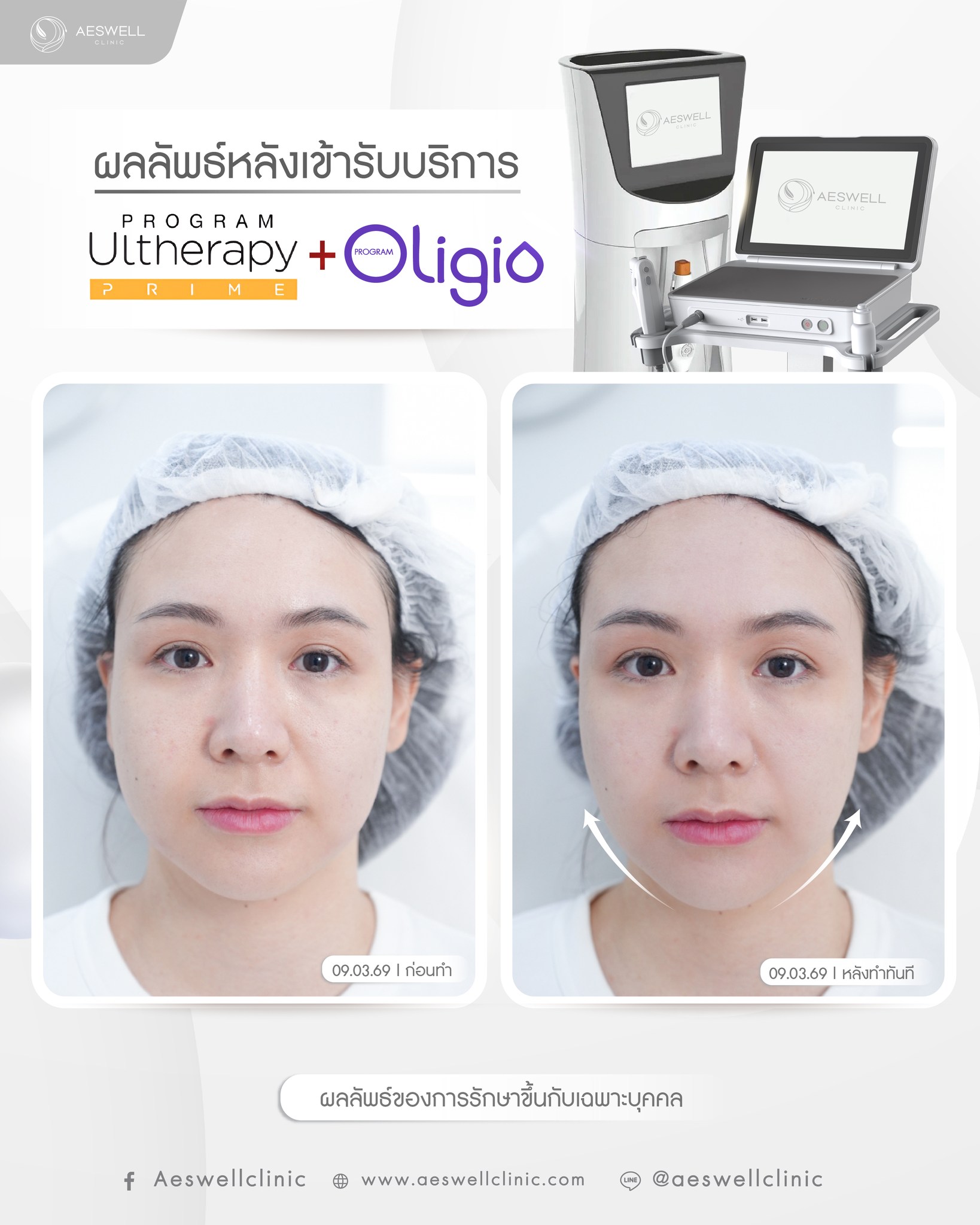 รีวิวหลังทำ โปรแกรม Oligio