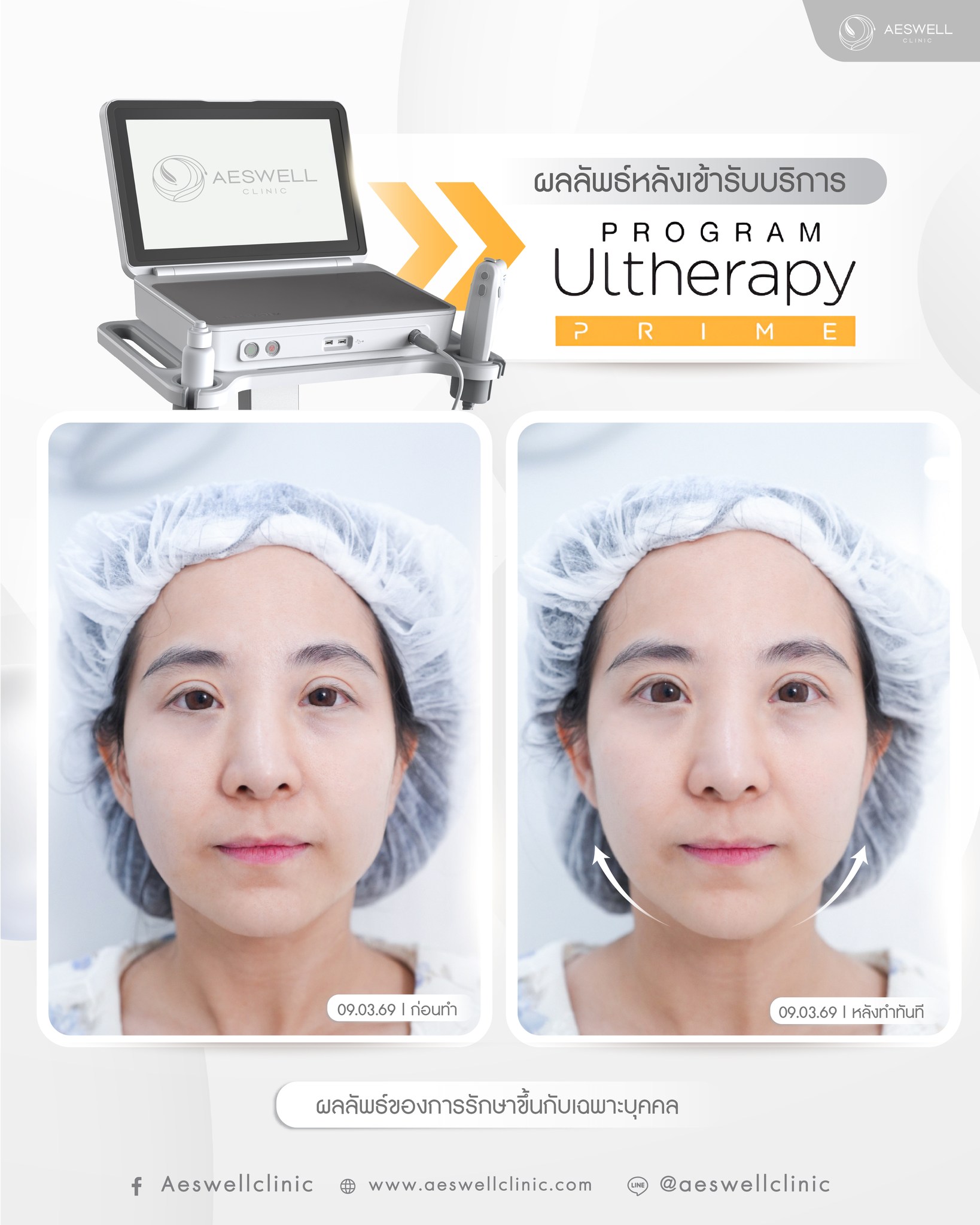ผลลัพธ์หลังทำ โปรแกรม Ultherapy Prime