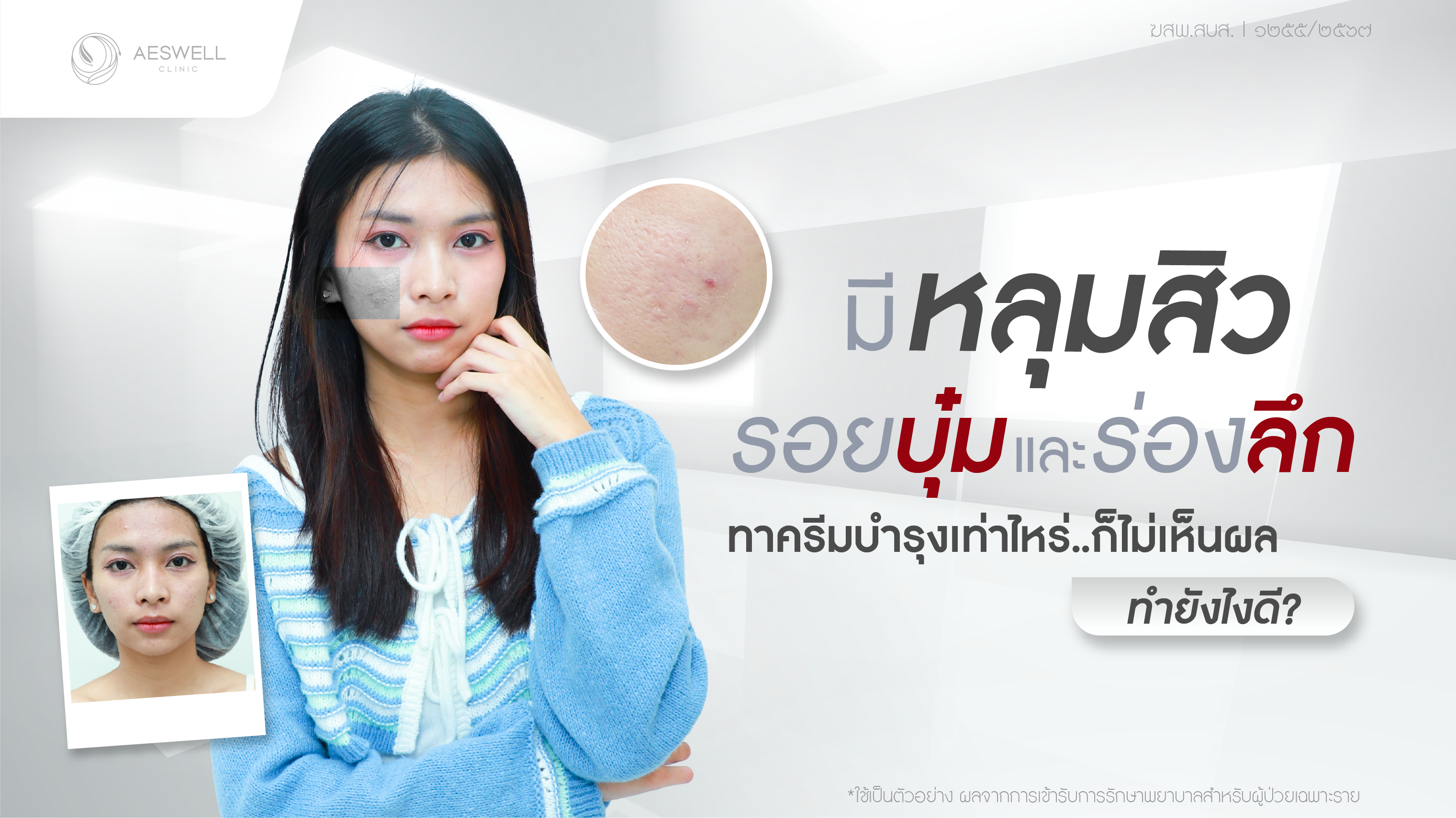 มีหลุมสิว รอยบุ๋ม และร่องลึก ทาครีมบำรุงเท่าไหร่ก็ไม่เห็นผลทำยังไงดี