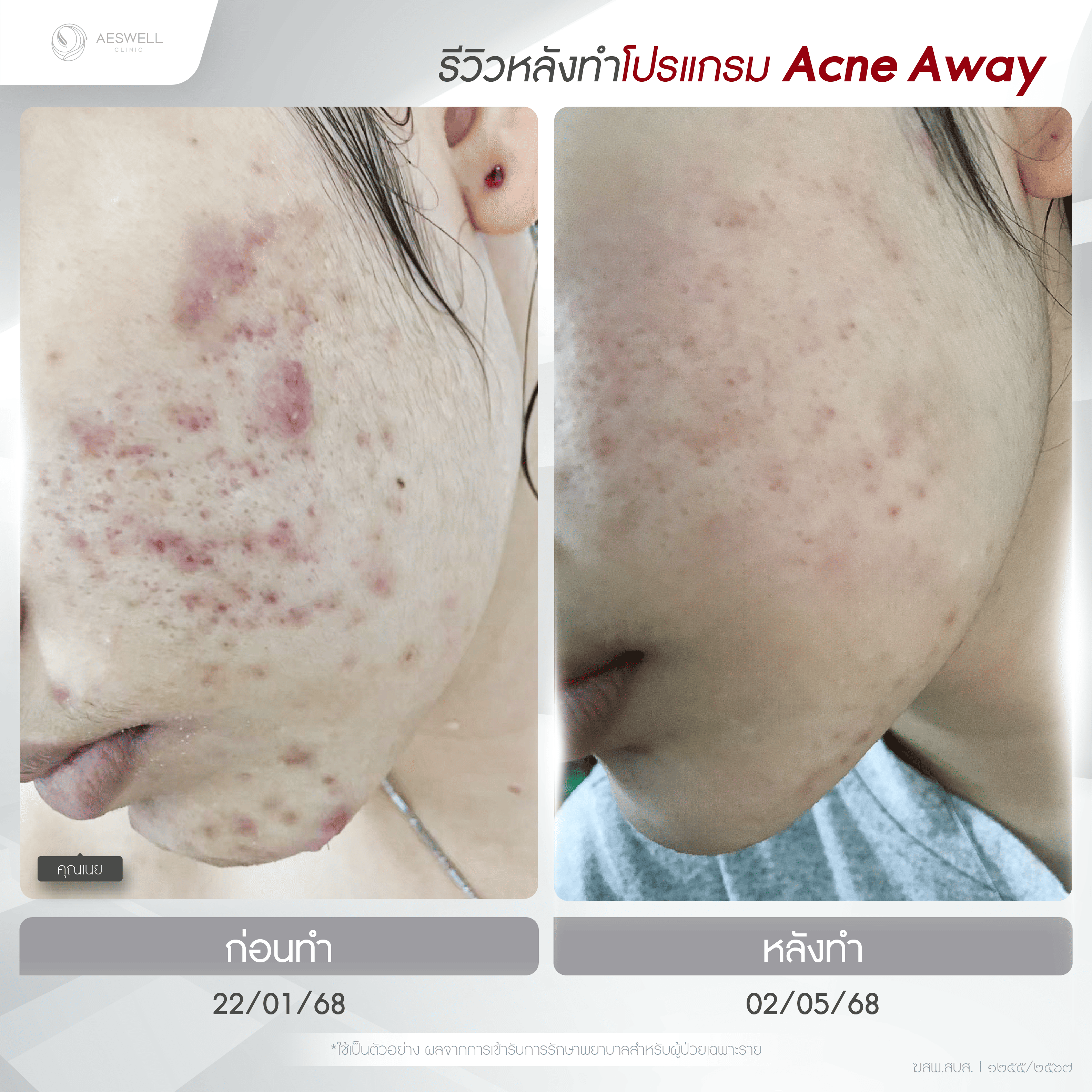 ภาพรีวิวหลังทำโปรแกรม AcneAway