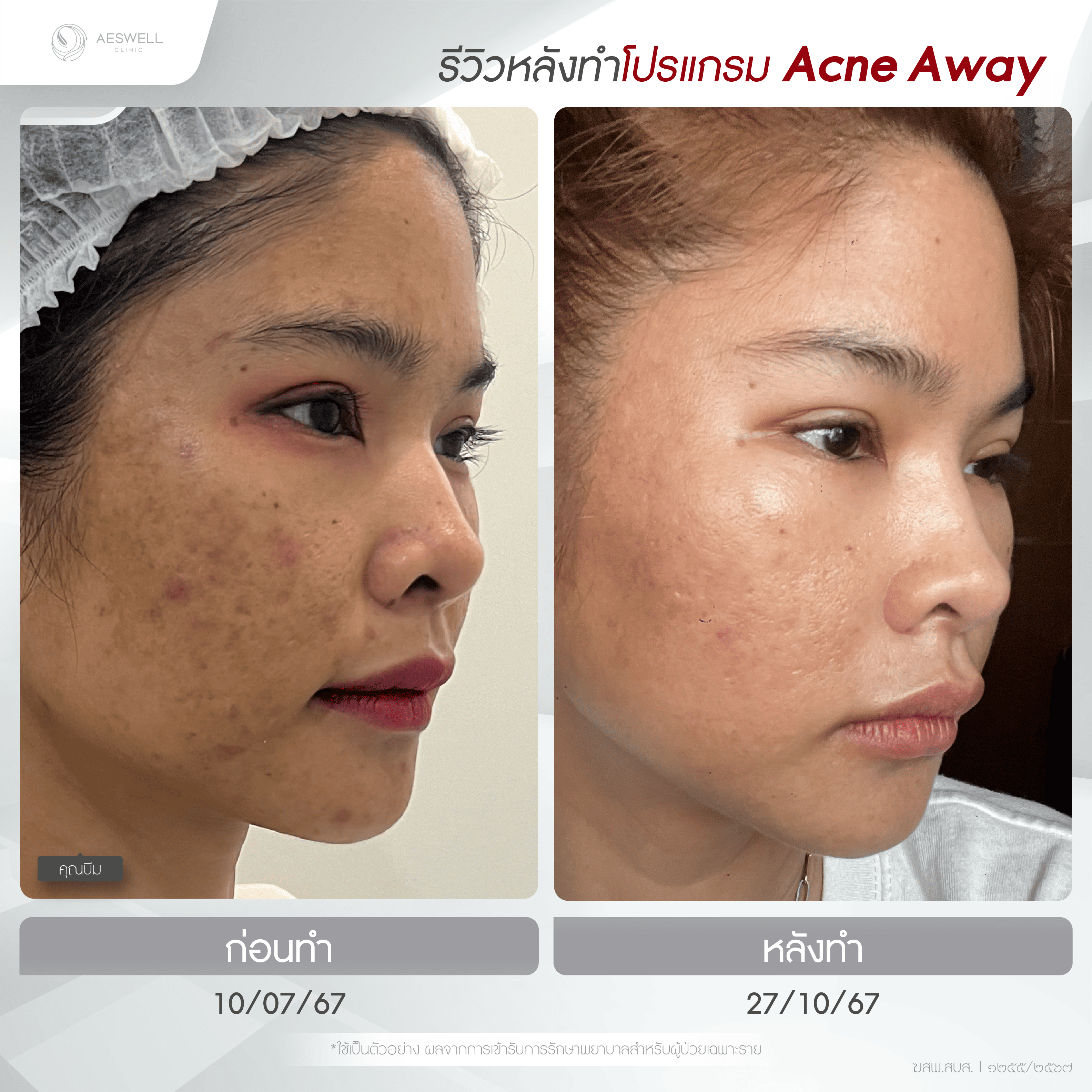 ภาพรีวิวหลังทำโปรแกรม AcneAway