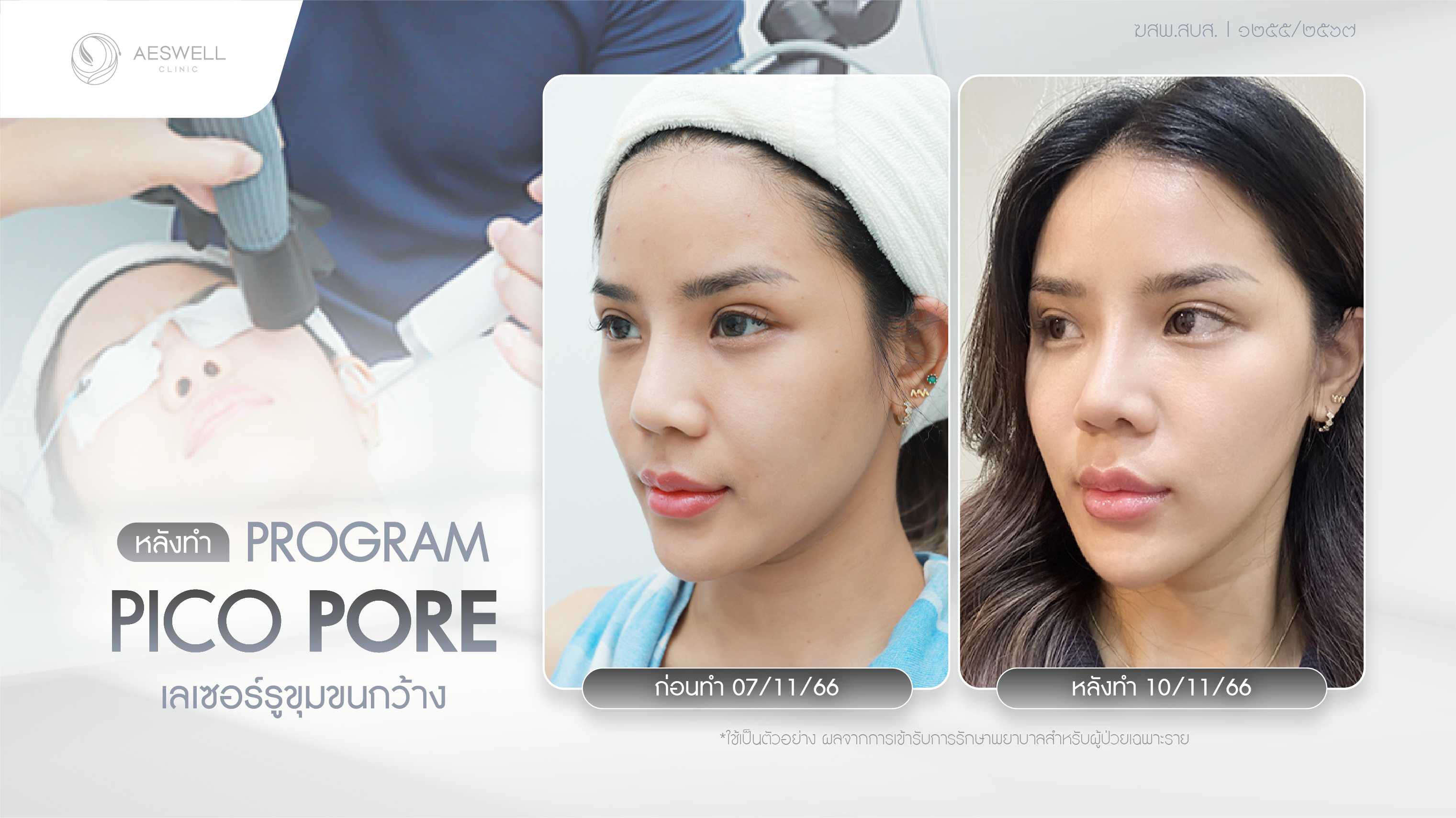 หลังทำโปรแกรม Pico pore เลเซอร์รูขุมขนกว้าง