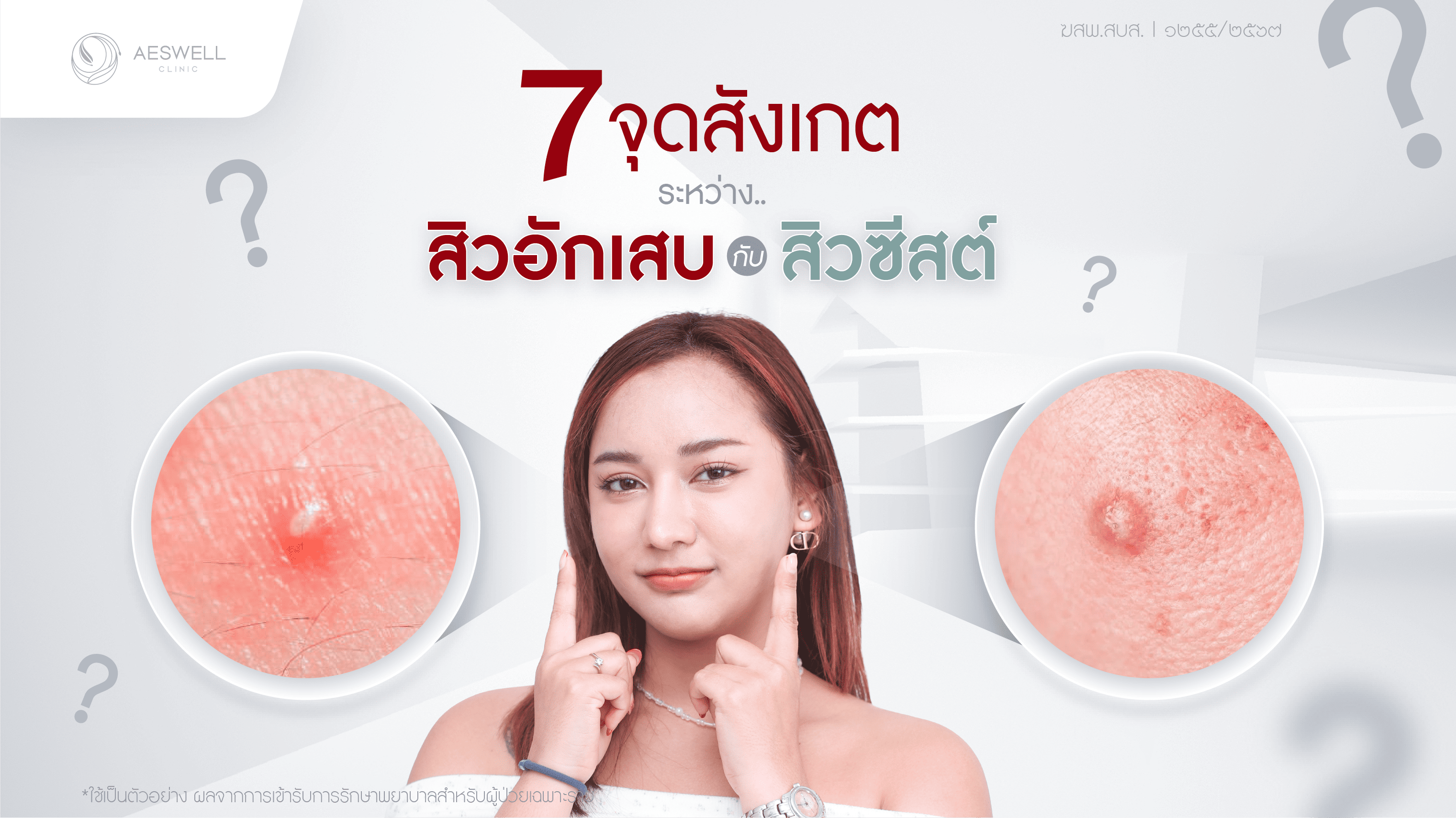 7 จุดที่ต้องสังเกต ระหว่างสิวอักเสบกับสิวซีสต์
