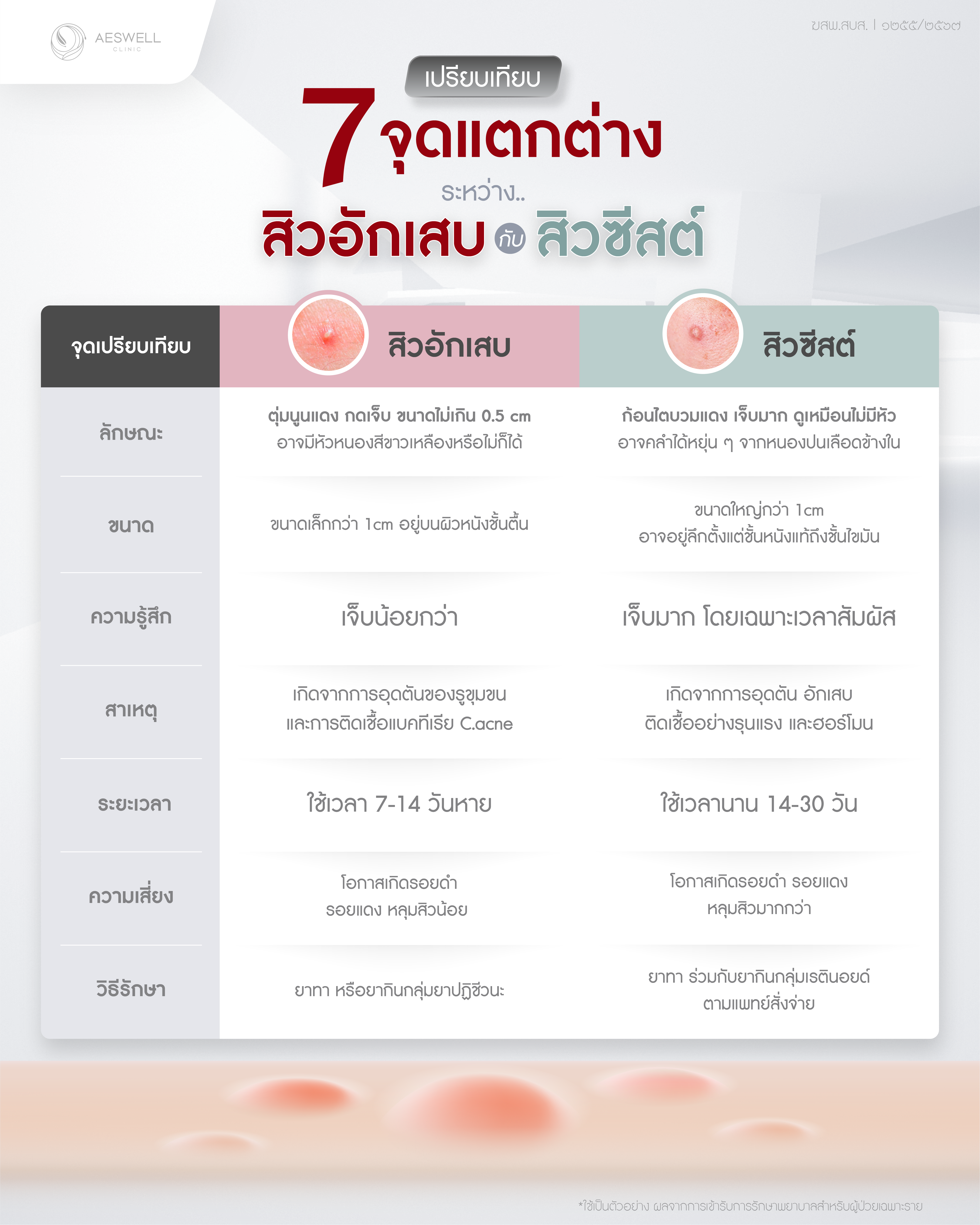 เปรียบเทียบ 7 จุดแตกต่าง ระหว่างสิวอักเสบกับสิวซีสต์