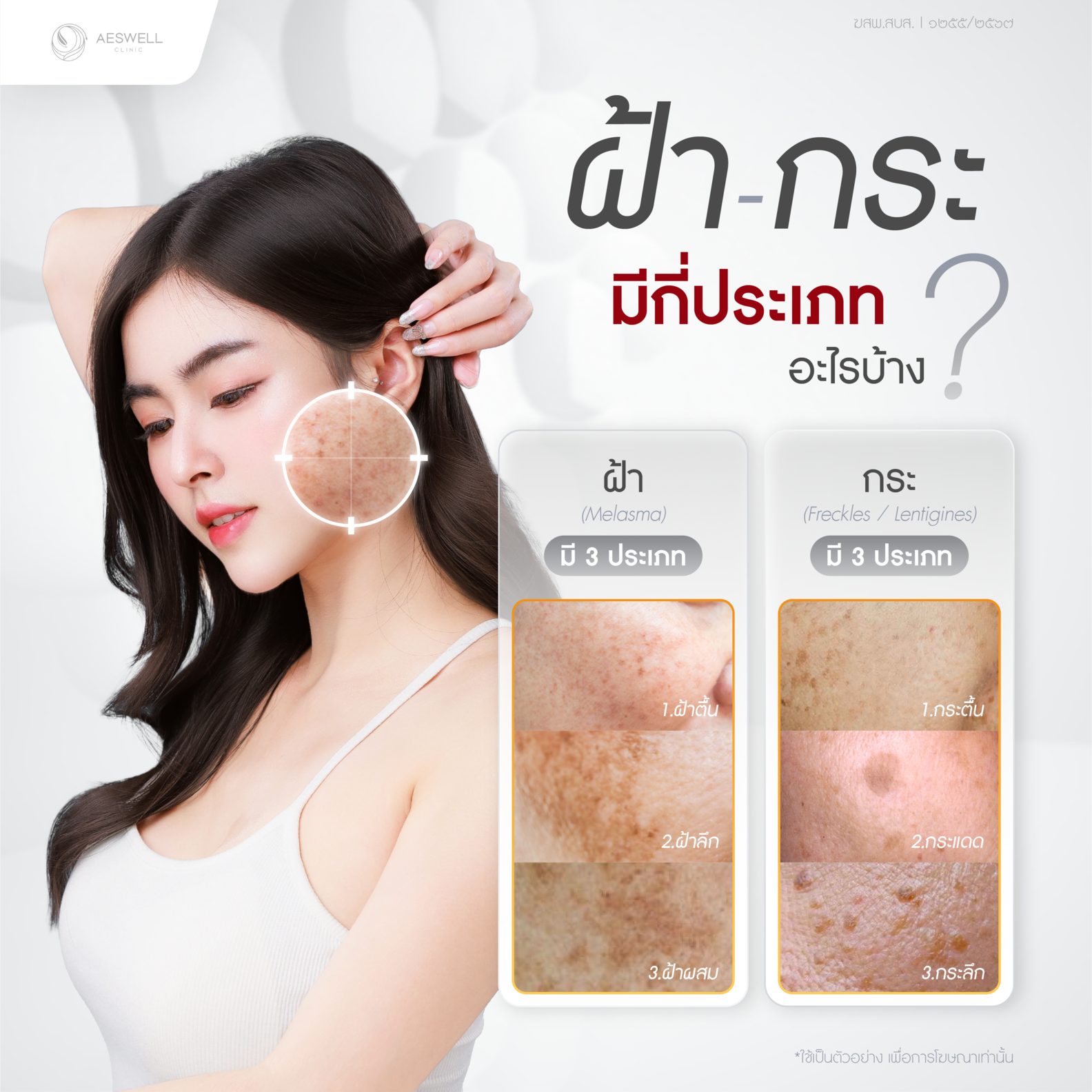 ฝ้า กระ มีกี่ประเภท อะไรบ้าง ฝ้า กระ มีกี่ประเภท อะไรบ้าง