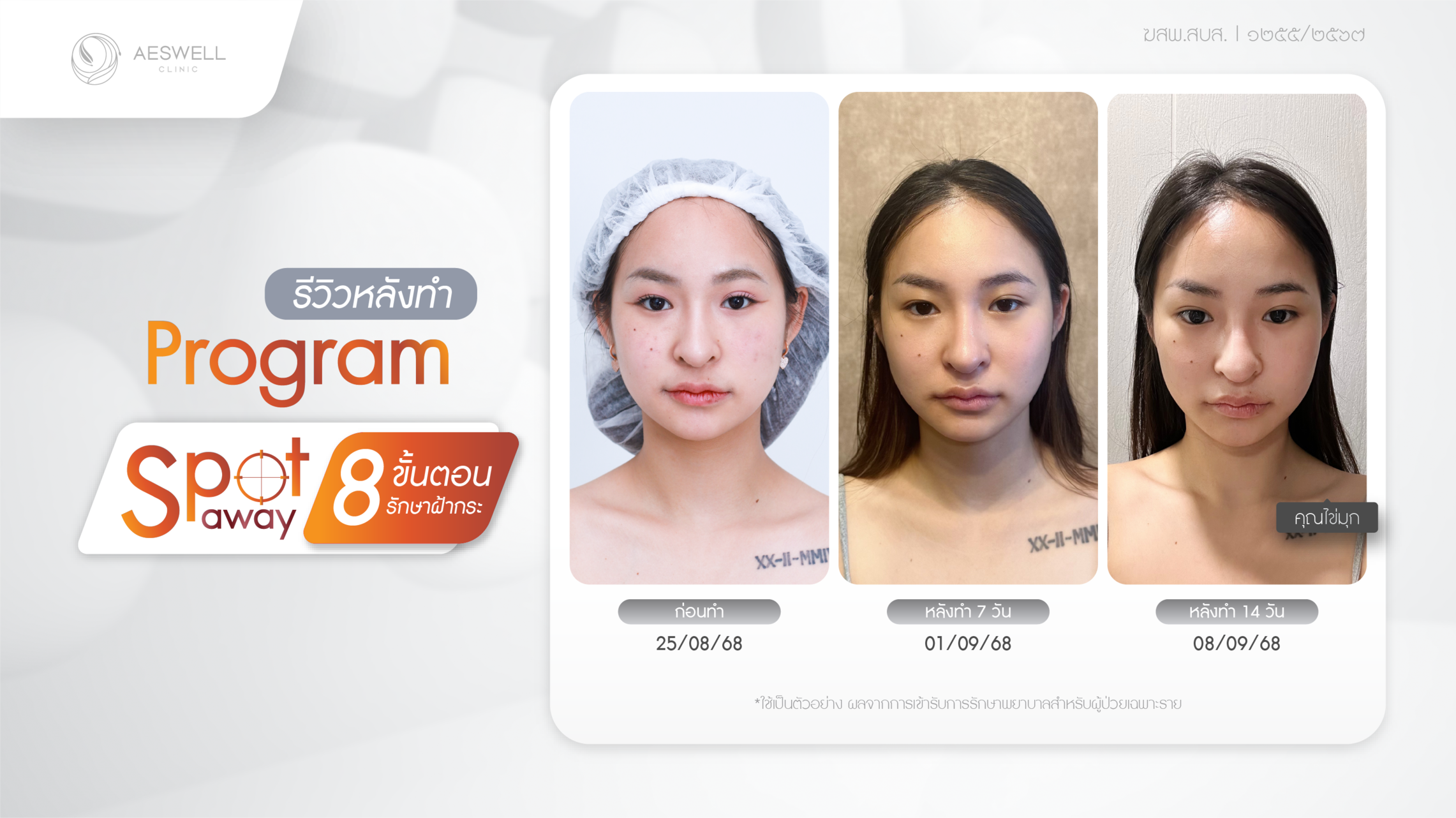 รีวิวภาพหลังทำ Spot Away Program รักษาฝ้ากระ รีวิวภาพหลังทำ Spot Away Program รักษาฝ้ากระ