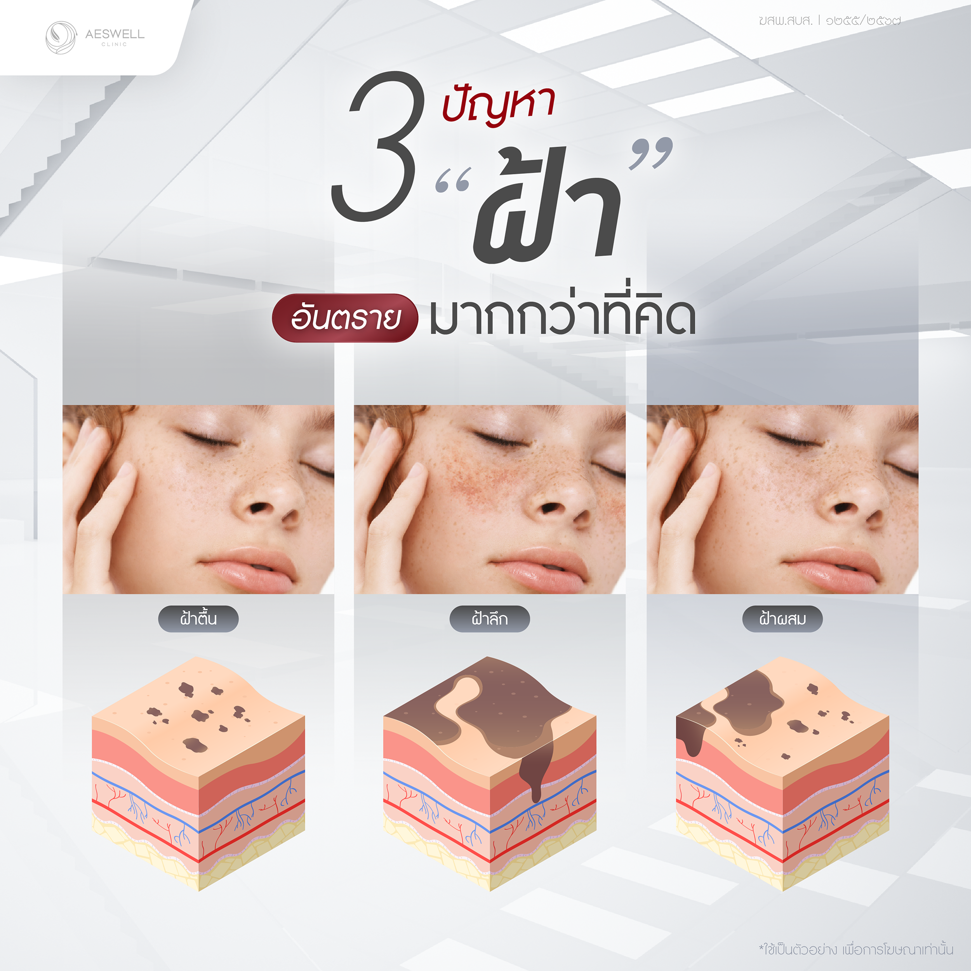 ประเมินระดับความรุนแรงของฝ้าก่อนรักษา