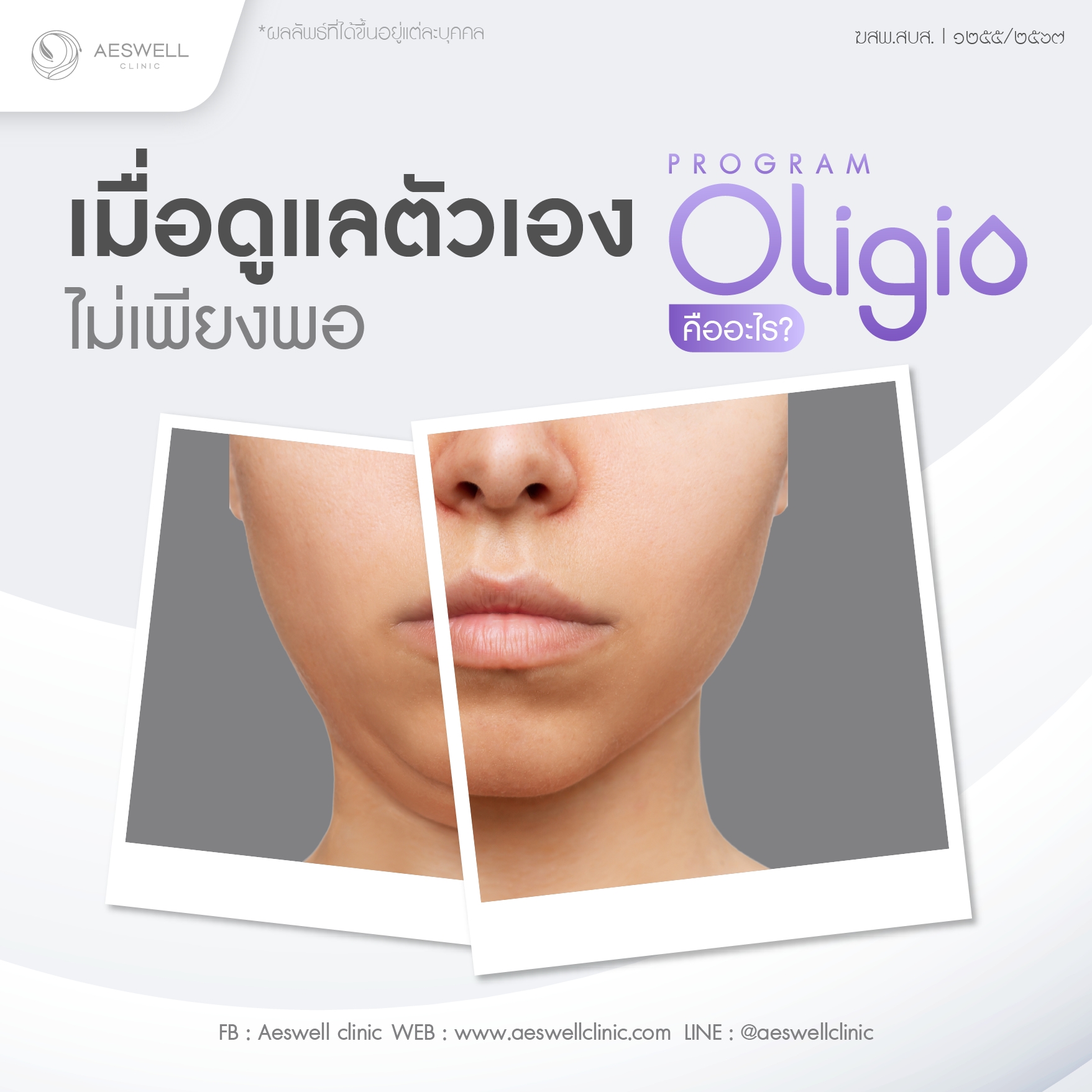 เมื่อดูแลเองไม่เพียงพอ โปรแกรม Oligio คืออะไร?