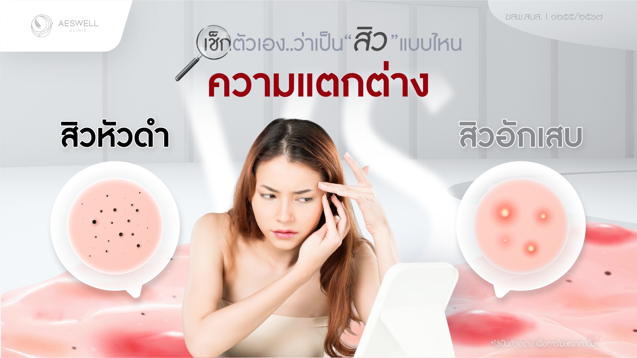 ความแตกต่างของ สิวหัวดำ และสิวอักเสบ