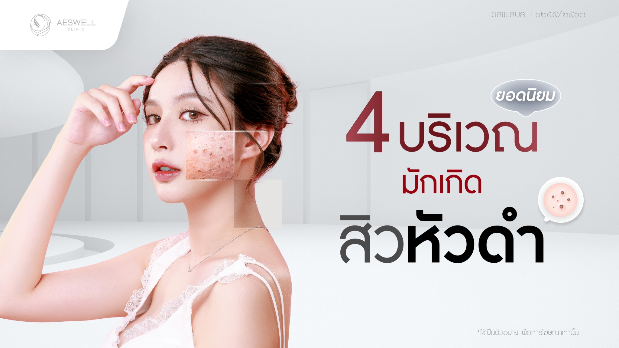 บริเวณที่มักเกิด สิวหัวดำ