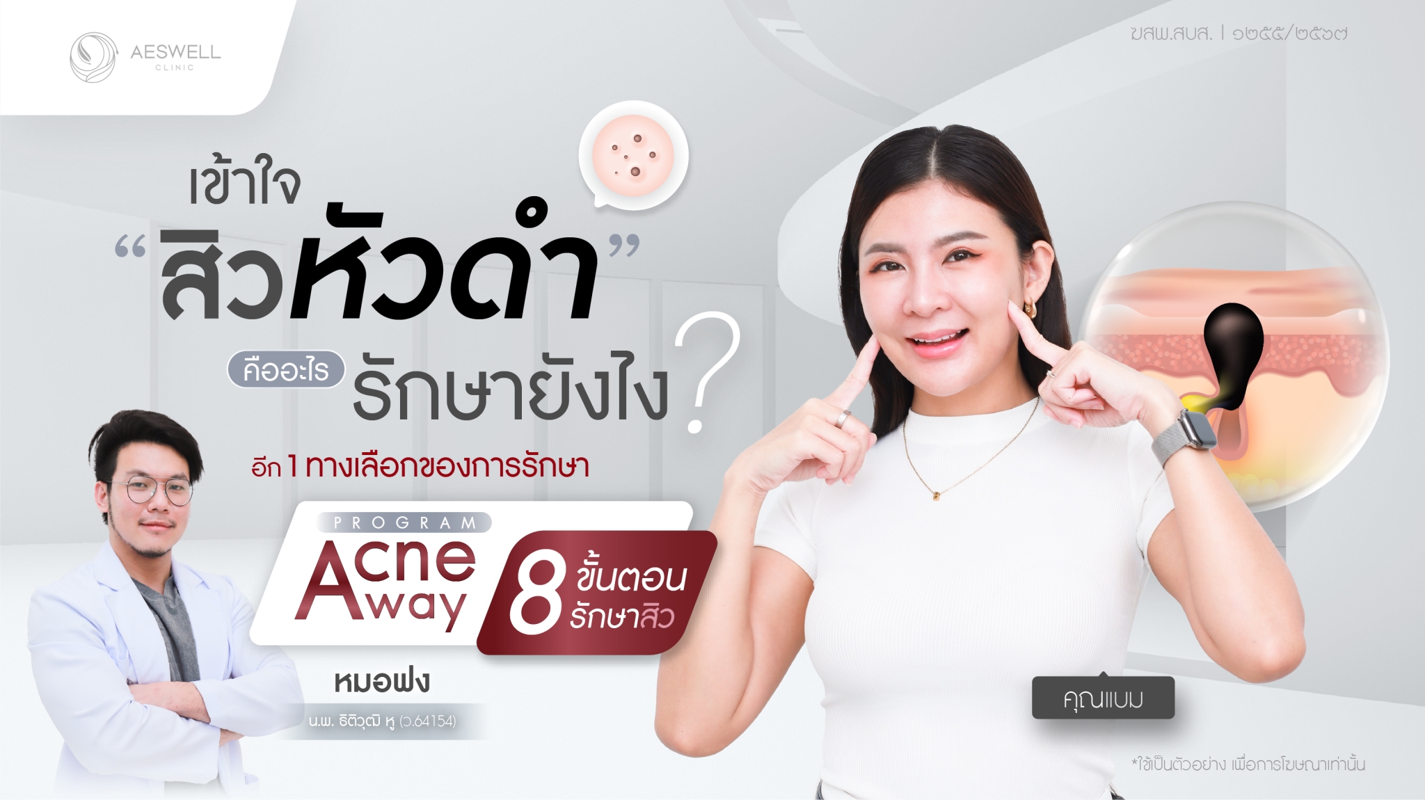 เรื่อง เข้าใจ “สิวหัวดำ” คืออะไร รักษายังไง จัดการด้วย! โปรแกรม Acne Away