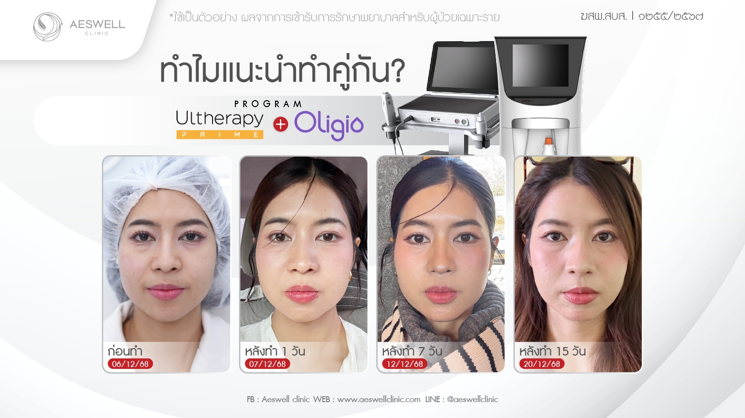 ทำไมแนะนำ โปรแกรม Ulthera Prime + โปรแกรม Oligio คู่กัน?