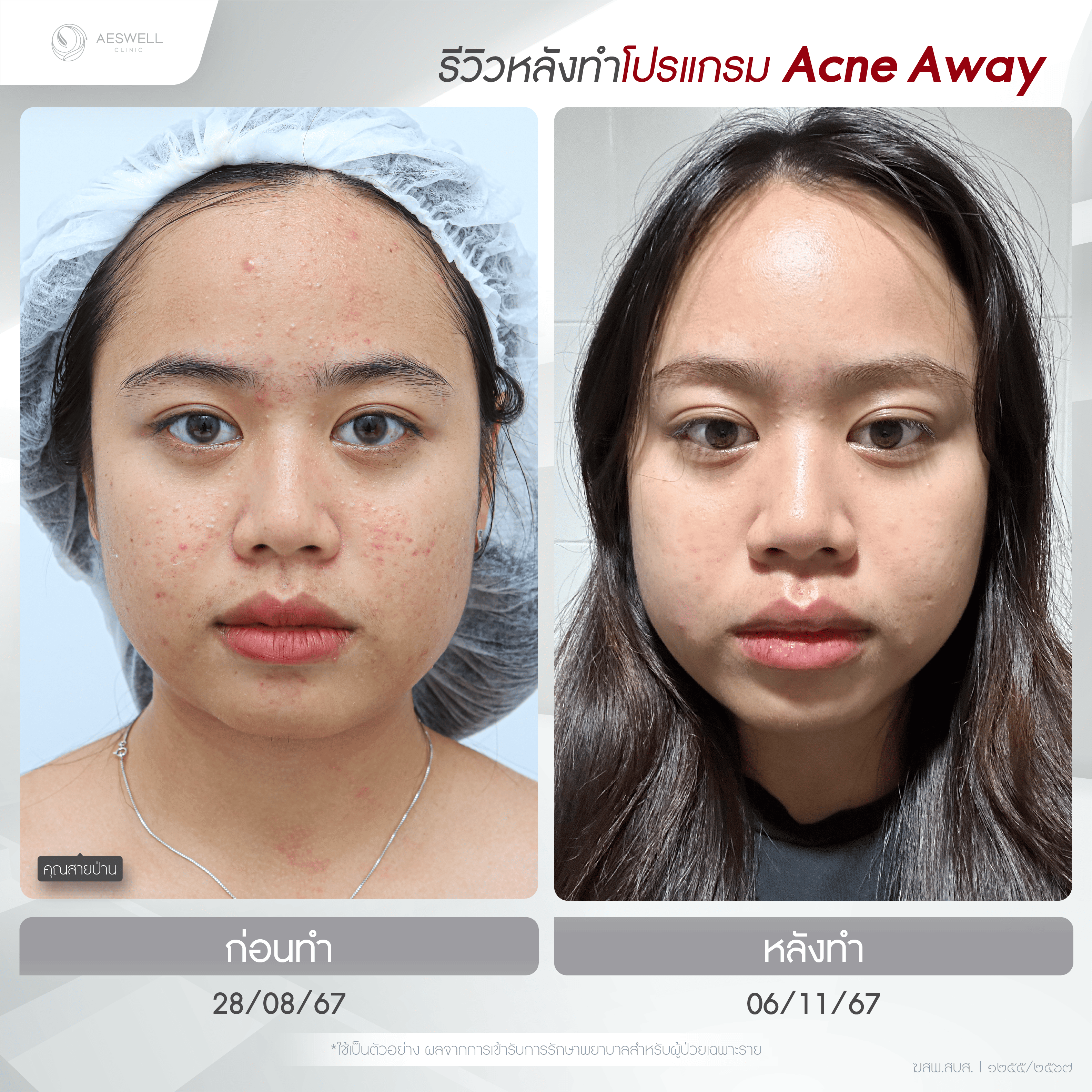 ภาพรีวิวหลังทำโปรแกรม AcneAway