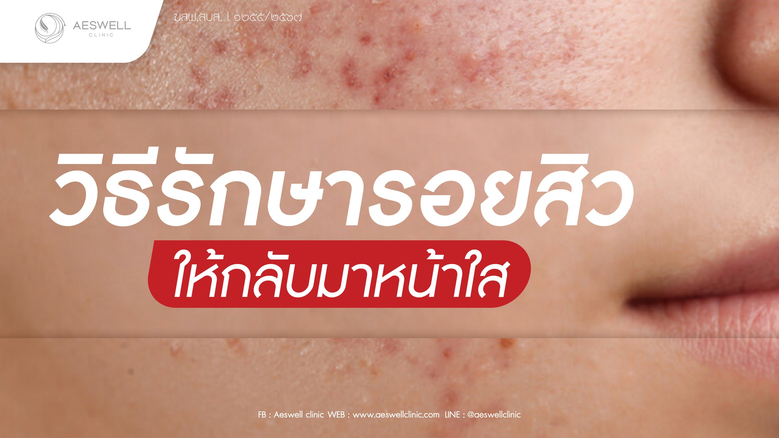 วิธีรักษารอยสิว ให้กลับมาหน้าใส