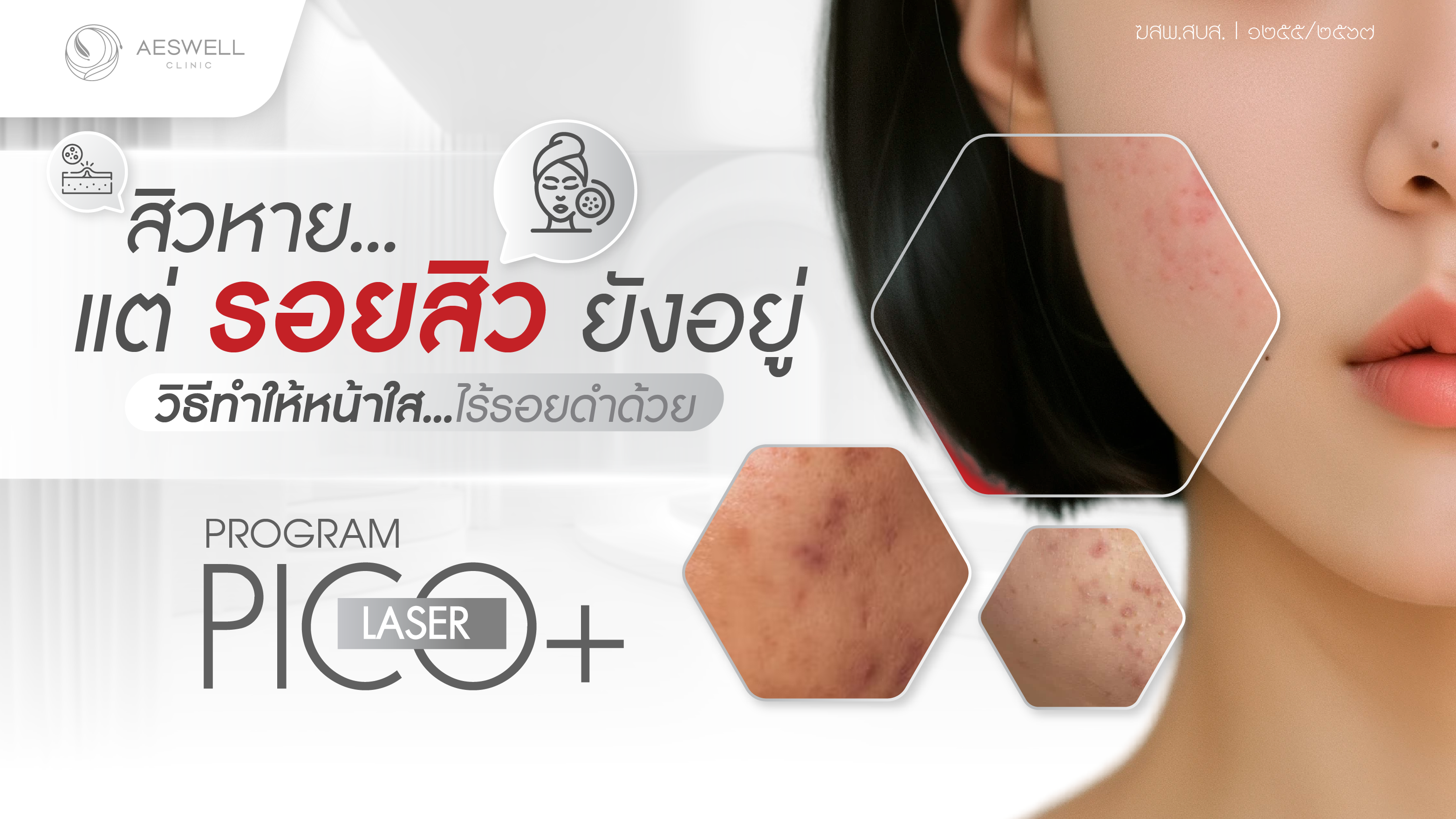 สิวหายแต่รอยสิวยังอยู่ วิธีทำให้หน้าใส ไร้รอยดำ ด้วยโปรแกรม Pico Laser