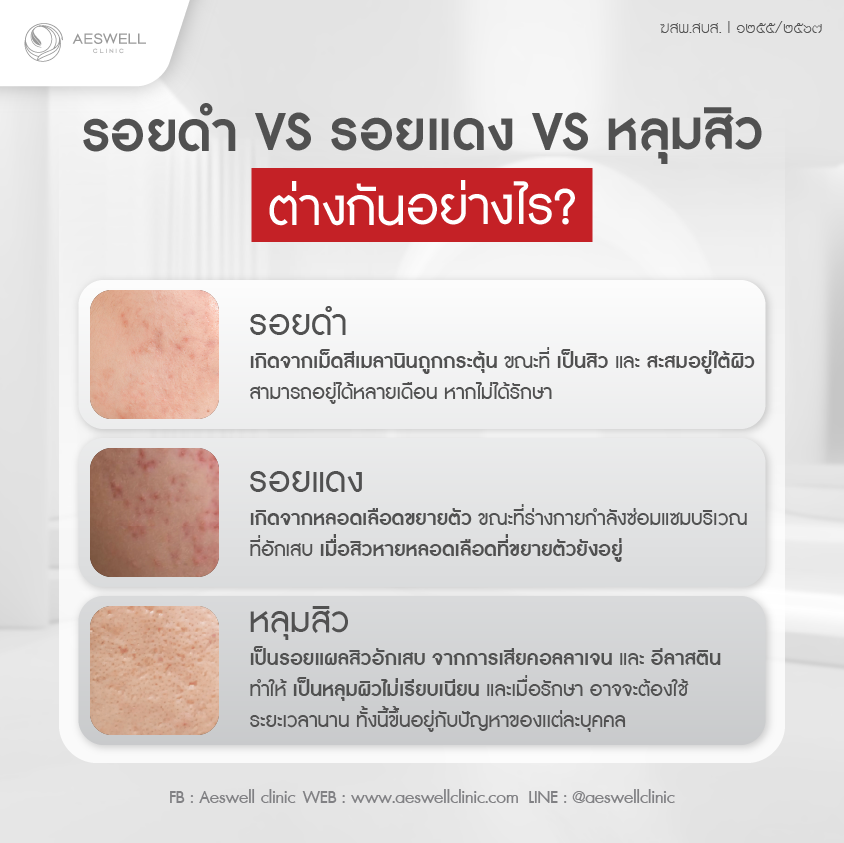 รอยดำ VS รอยแดง VS หลุมสิว - ต่างกันอย่างไร?