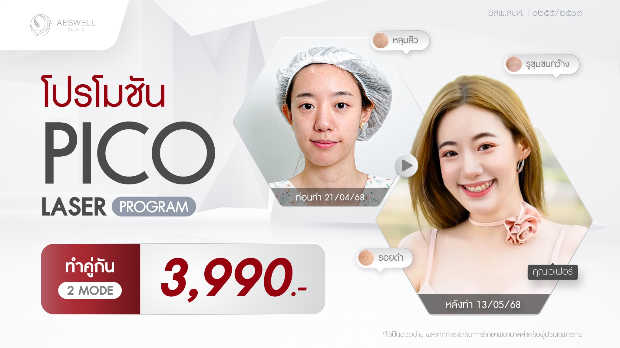 โปรโมชัน pico laser