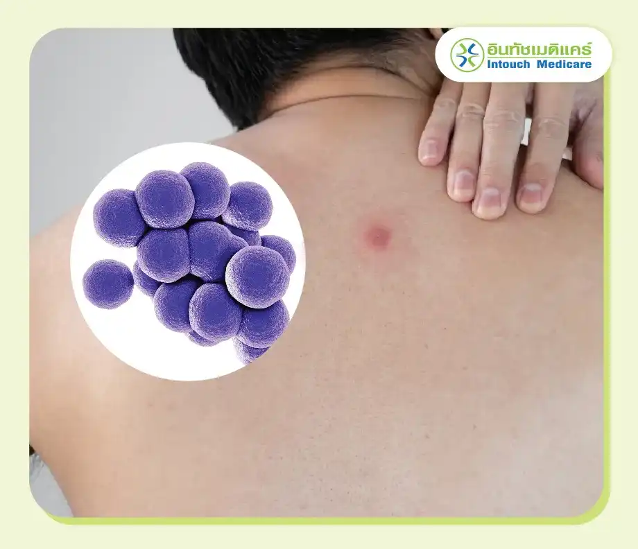 Causes of Abscesses? Causes of Abscesses?