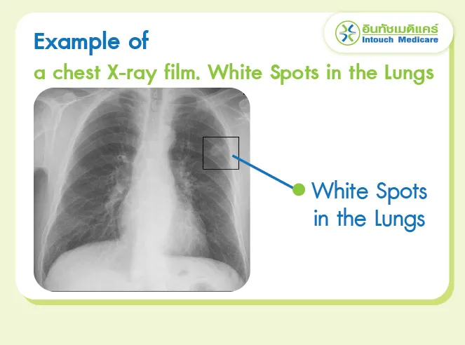 Example of a chest X-ray film. White Spots in the Lungs