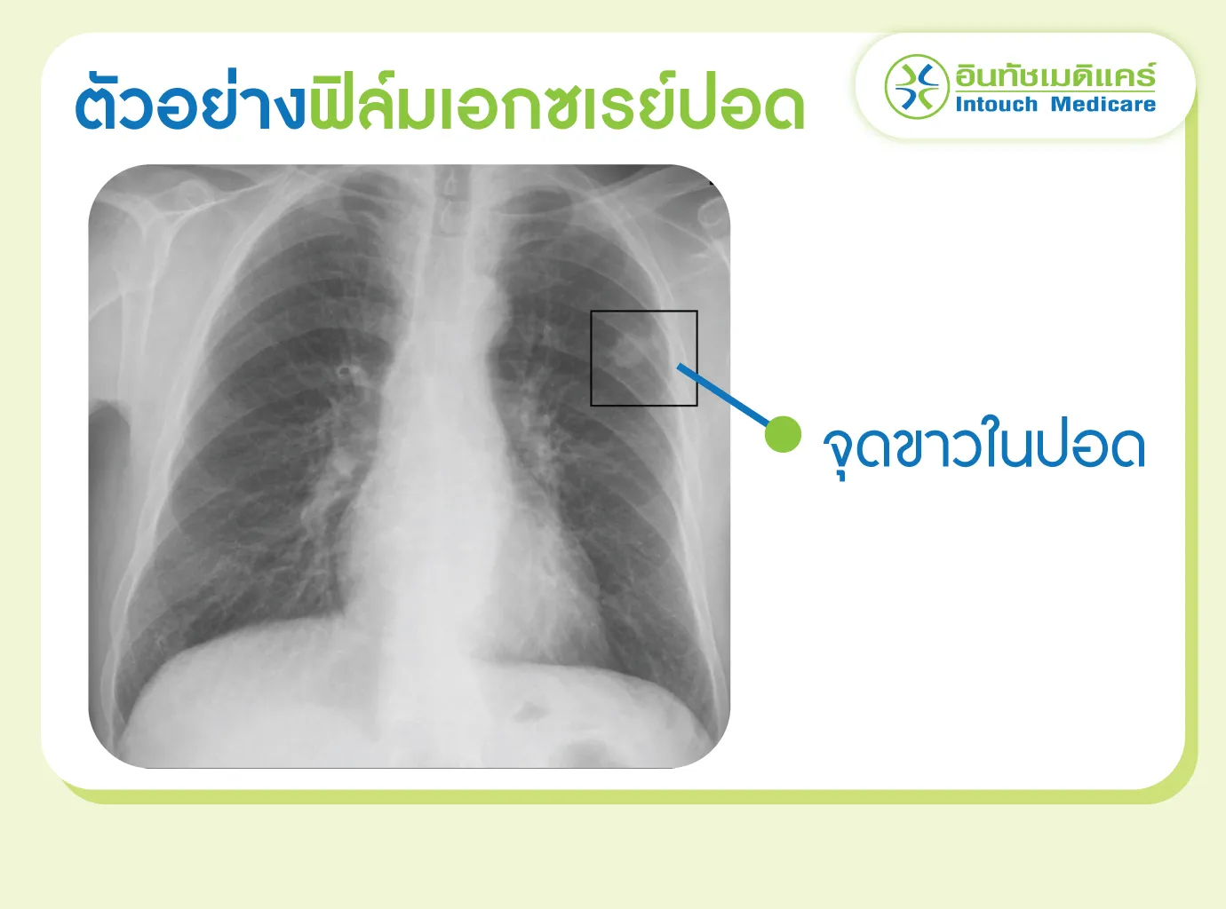 ตัวอย่างภาพเอกซเรย์ปอด พบจุดขาวในปอด