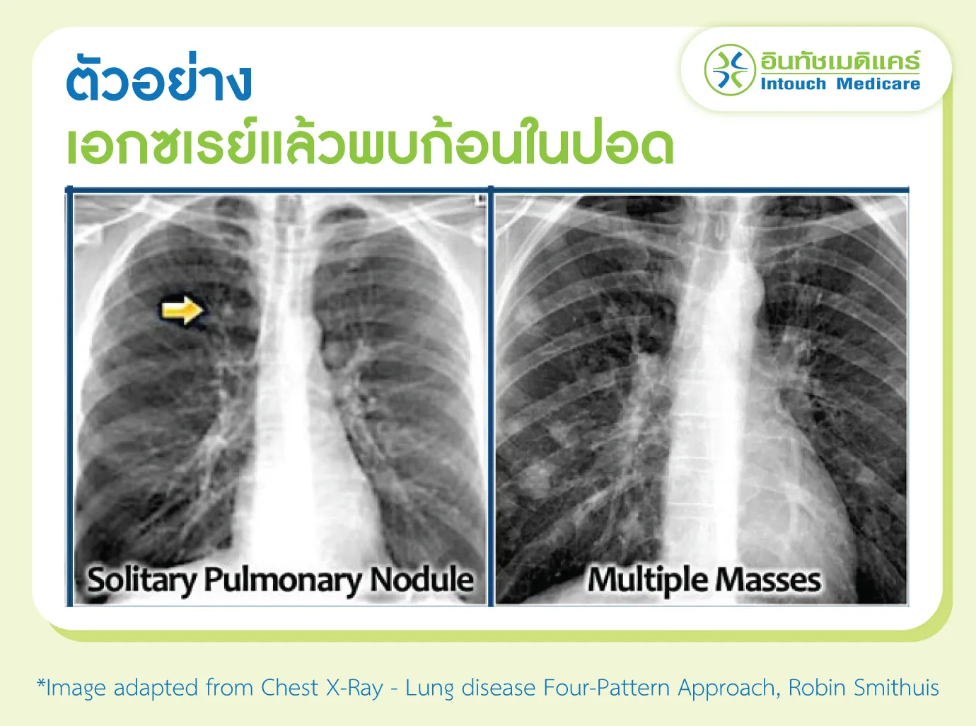 ตัวอย่าง เอกซเรย์แล้วพบก้อนในปอด