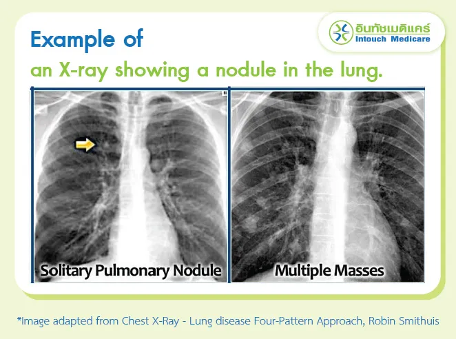 Example of an X-ray showing a nodule in the lung.