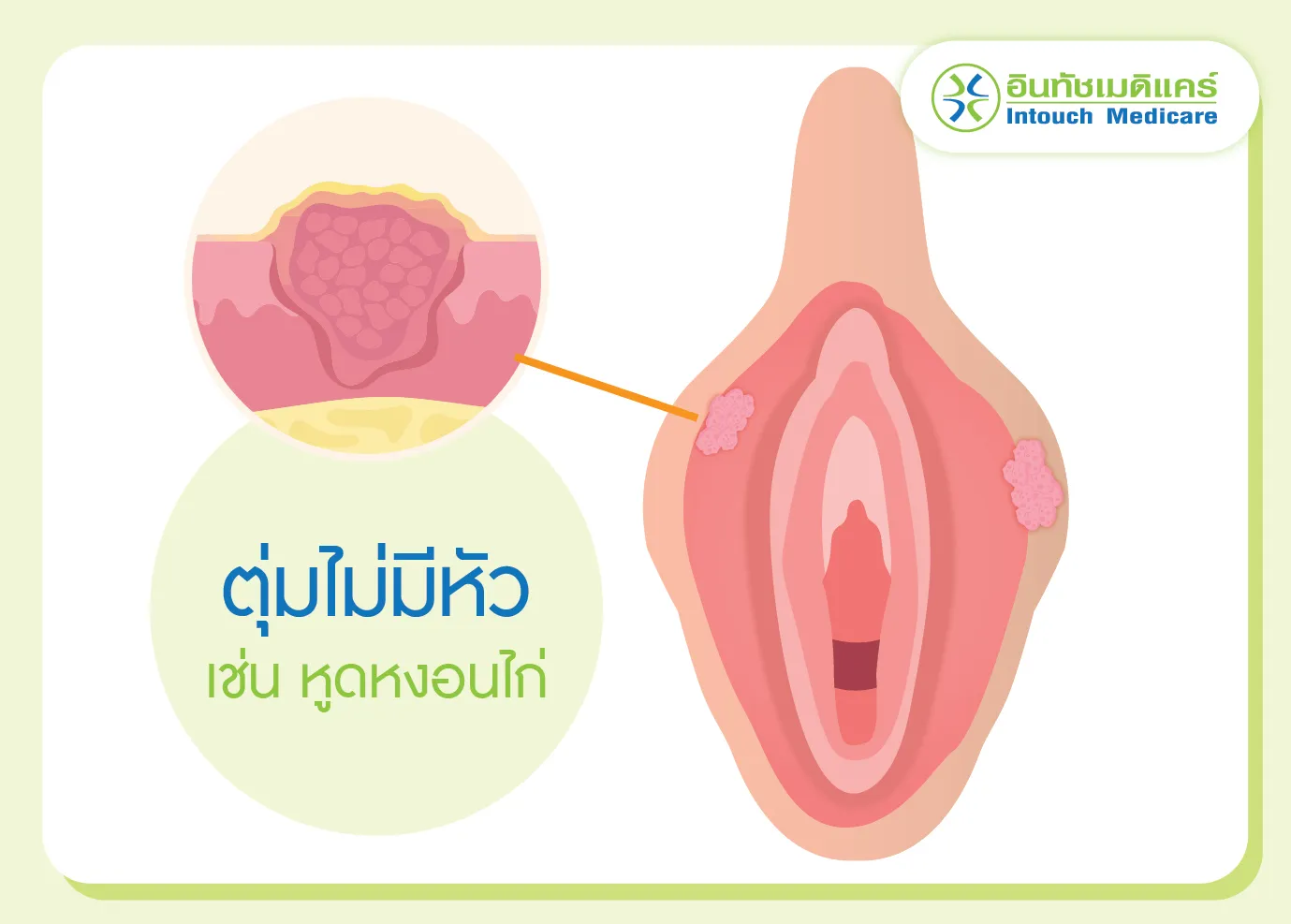 ตุ่มไม่มีหัวที่อวัยวะเพศหญิง เช่น หูดหงอนไก่ ตุ่มไม่มีหัวที่อวัยวะเพศหญิง เช่น หูดหงอนไก่