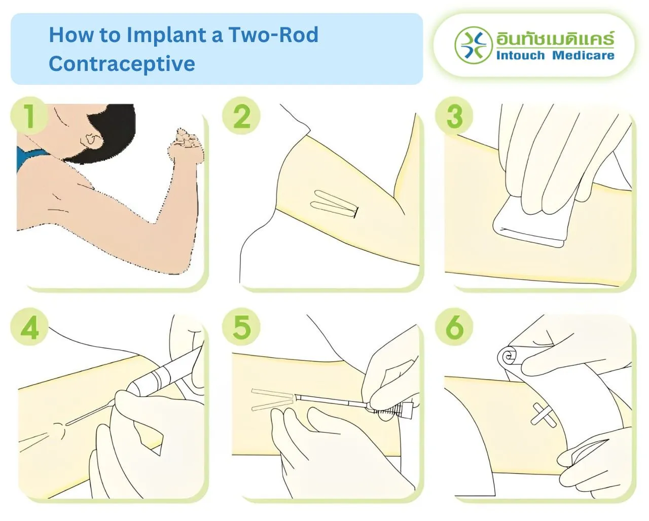 How to Implant a Two-Rod Contraceptive