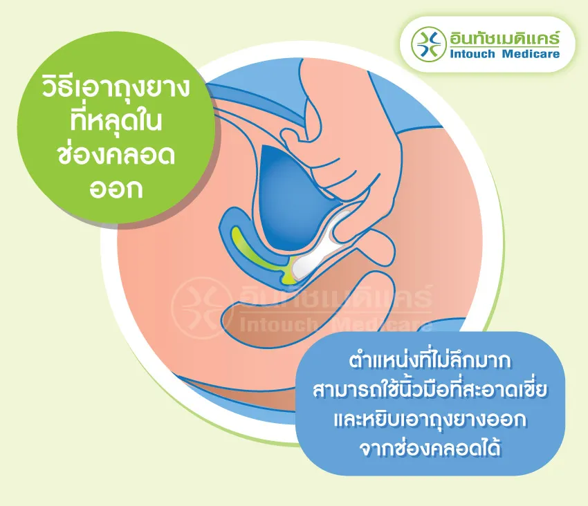 วิธีเอาถุงยางที่หลุดในช่องคลอดออก วิธีเอาถุงยางที่หลุดในช่องคลอดออก