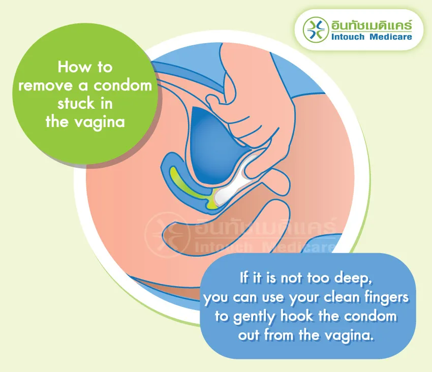 How to remove a condom stuck in the vagina