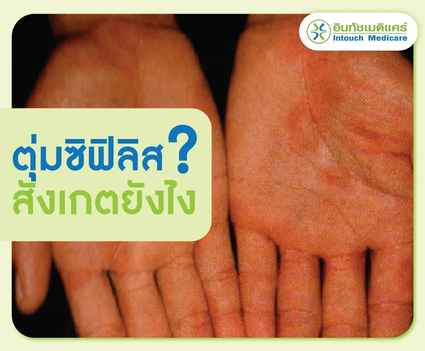 ตุ่มซิฟิลิสสังเกตยังไง