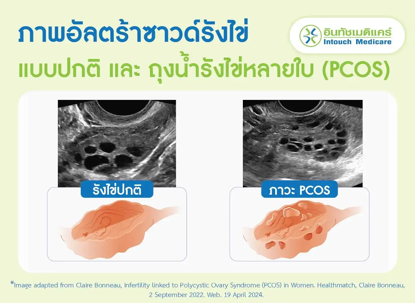 ภาพอัลตร้าซาวด์รังไข่แบบปกติ และ ถุงน้ำรังไข่หลายใบ (PCOS)  ภาพอัลตร้าซาวด์รังไข่แบบปกติ และ ถุงน้ำรังไข่หลายใบ (PCOS)