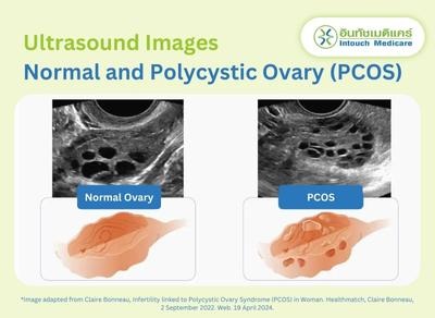 Normal and Polycystic Ovary (PCOS) Ultrasound Images