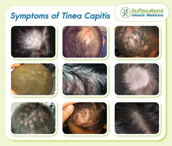 Symptoms of Tinea Capitis