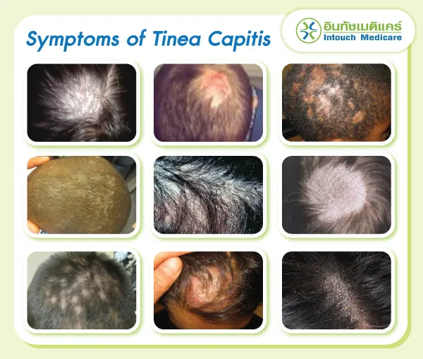 Tinea Capitis