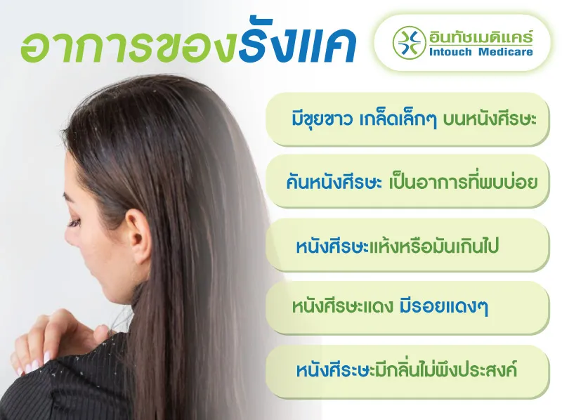 อาการรังแค อาการรังแค
