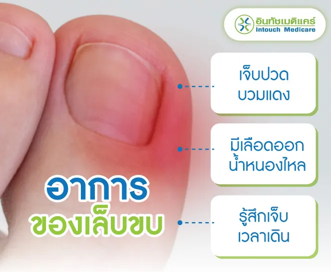 อาการของเล็บขบ อาการของเล็บขบ