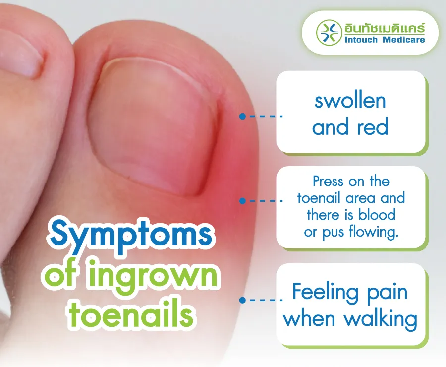 Symptoms of ingrown toenails