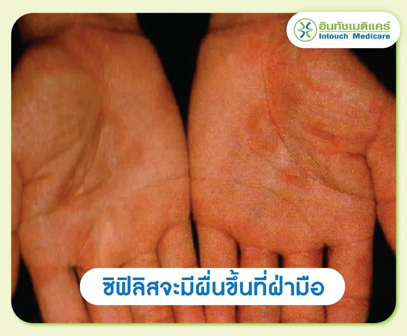 แผลที่ฝ่ามือเป็นอาการของซิฟิลิส แผลที่ฝ่ามือเป็นอาการของซิฟิลิส