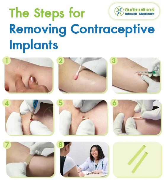 The Steps for Removing Contraceptive Implants