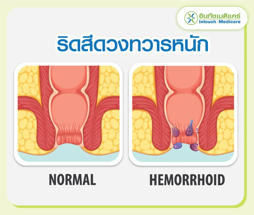 ริดสีดวงทวารคืออะไร