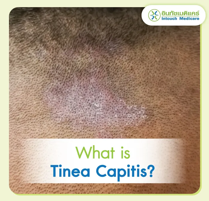 Tinea Capitis How to treat itchy head and dandruff?