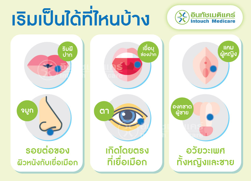 โรคเริมเป็นได้ที่ไหนบ้าง โรคเริมเป็นได้ที่ไหนบ้าง